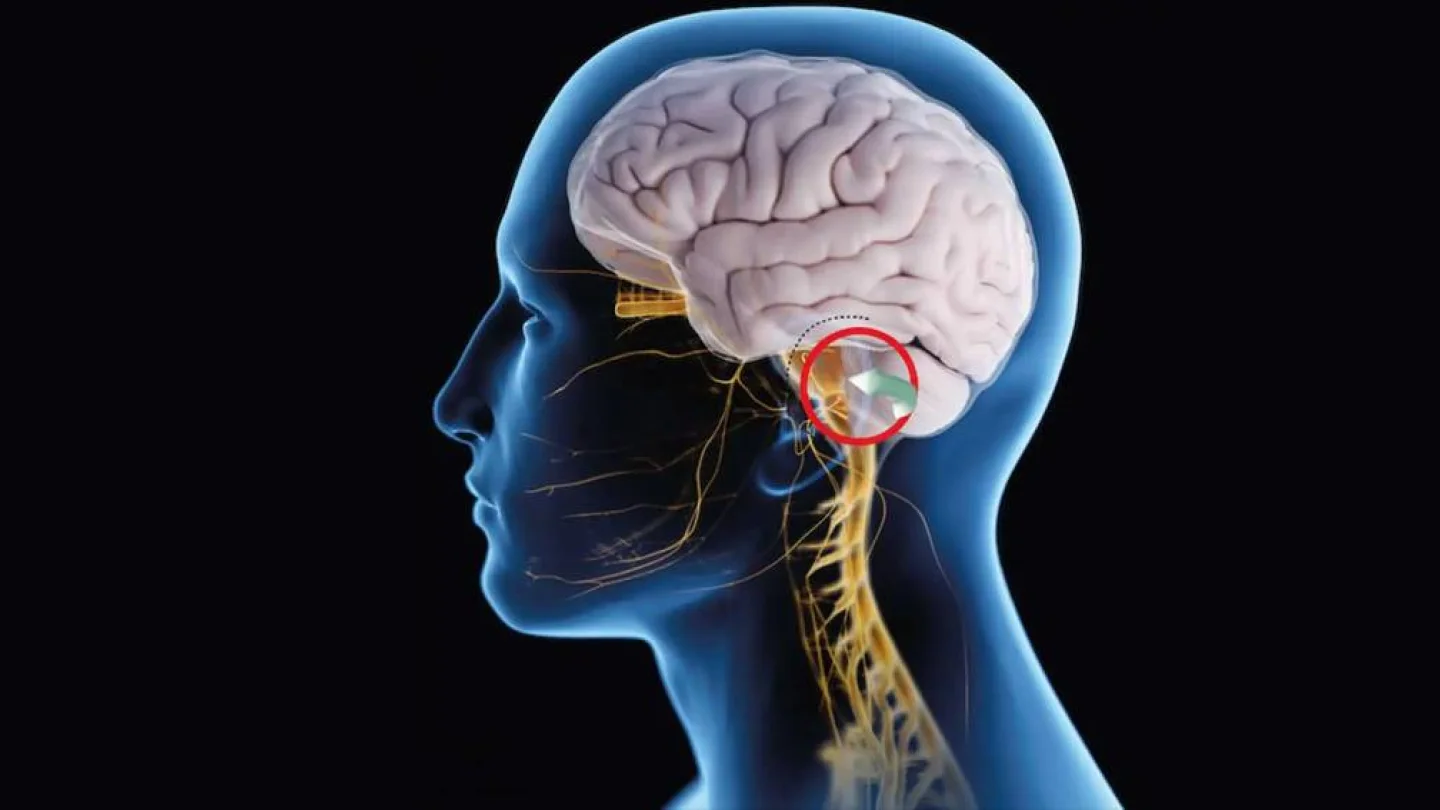 Trigeminal Nevralji