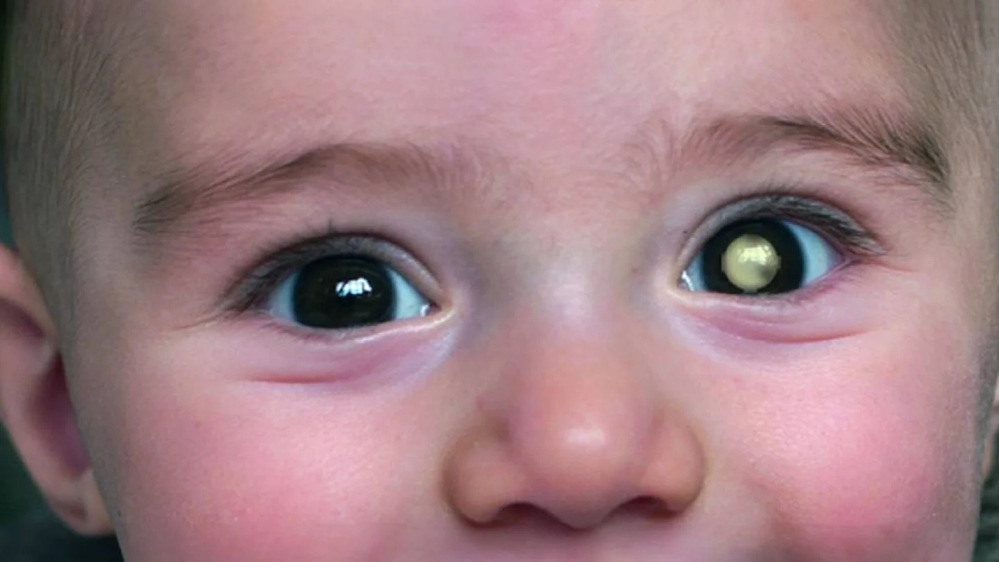 Retinoblastom 