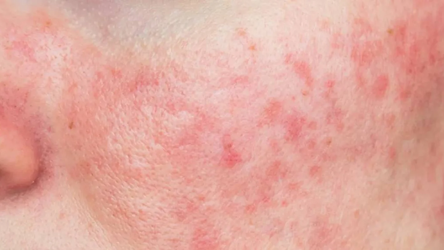 Rosacea 