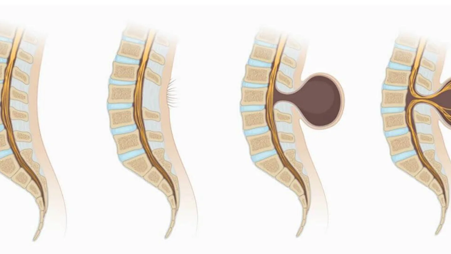 Spina Bifida