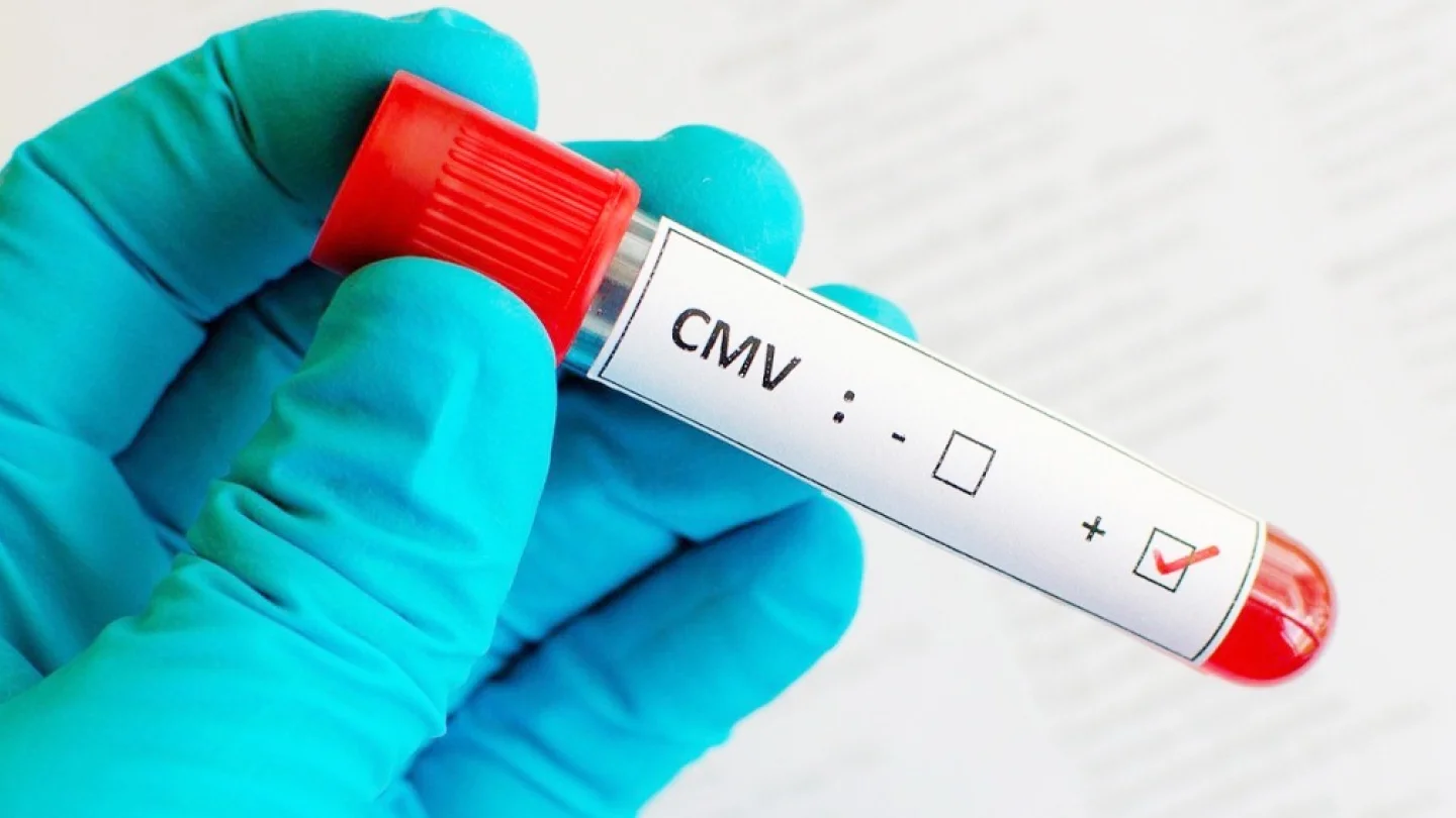 Sitomegalovirüs (CMV)