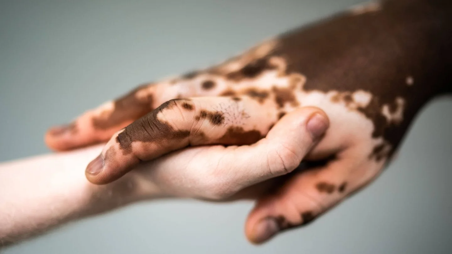 Vitiligo
