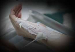 Çocuklarda yanık yarası II