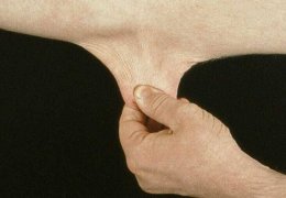 Ehlers Danlos sendromu