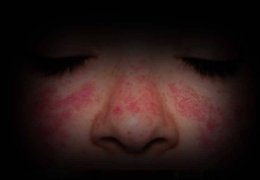 Sistemik Lupus Eritematozus