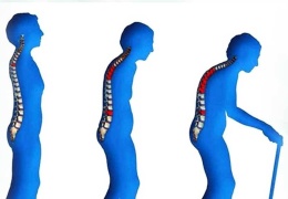 Osteoporoz (kemik erimesi)