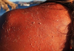 Güneşten korunmanın önemi ve yöntemleri