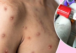 Maymun çiçeği belirtileri, tedavisi ve önlemler 