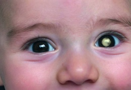Retinoblastom 