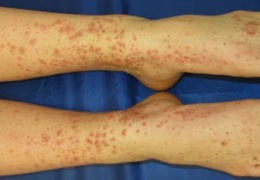 Henoch-Schönlein purpurası