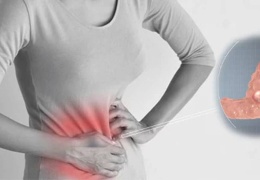 Polikistik over sendromu