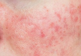 Rosacea 