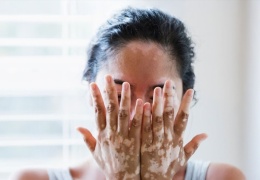 Addison hastalığı 