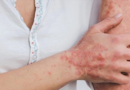 Epidermolizis Bülloza/Kelebek hastalığı