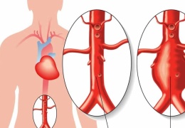 Aort anevrizması 