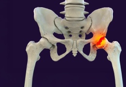 Perthes hastalığı