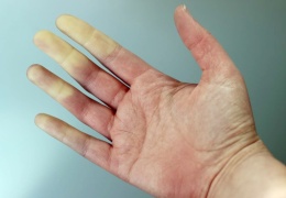 Raynaud hastalığı 