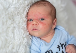 Çocuklarda ilaç alerjisi