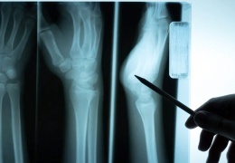 Cam kemik hastalığı