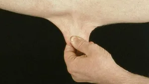 Ehlers Danlos sendromu
