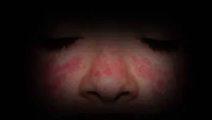Sistemik Lupus Eritematozus