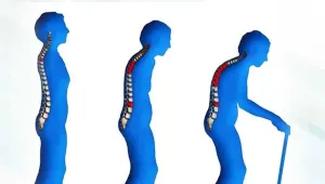 Osteoporoz (kemik erimesi)