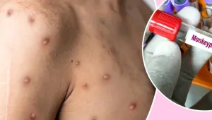 Maymun çiçeği belirtileri, tedavisi ve önlemler 