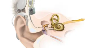 Koklear implant 