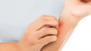 Kaşıntı 