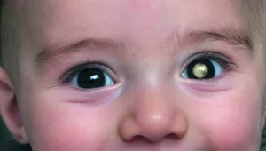 Retinoblastom 