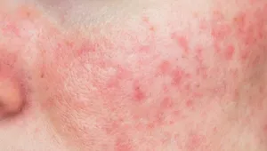 Rosacea 