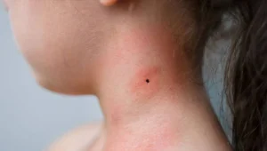 Lyme hastalığı 