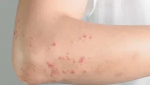 Nörofibromatozis