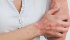 Epidermolizis Bülloza/Kelebek hastalığı