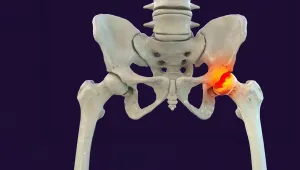 Perthes hastalığı