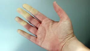Raynaud hastalığı 