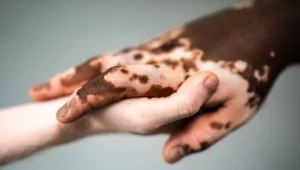 Vitiligo hastalığı