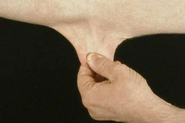 Ehlers Danlos sendromu