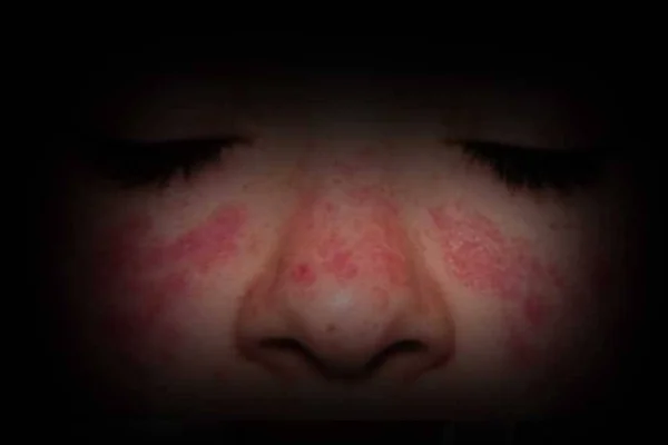 Sistemik Lupus Eritematozus