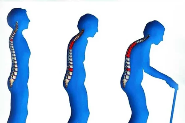 Osteoporoz (kemik erimesi)
