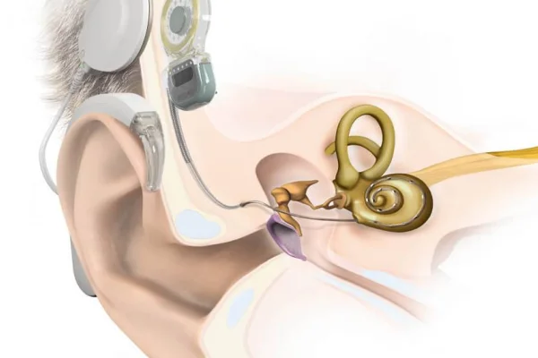 Koklear implant 