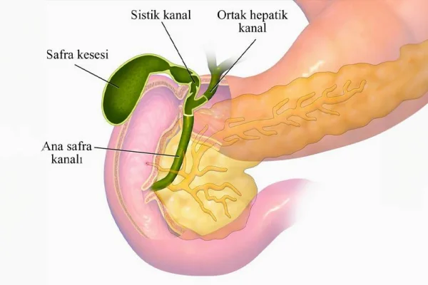 Safra kesesi taşı