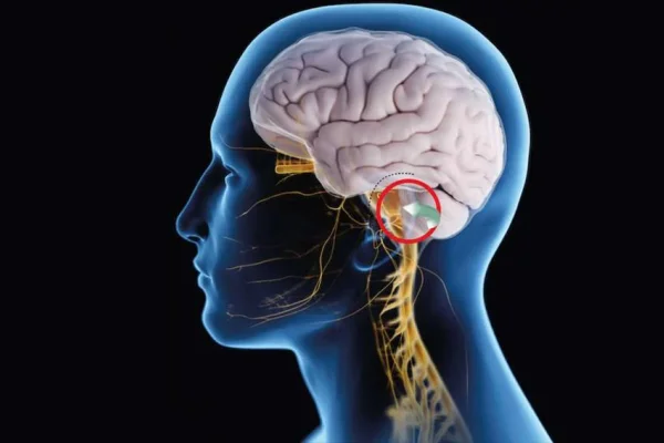 Trigeminal Nevralji 