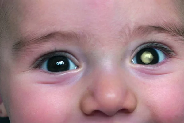 Retinoblastom 