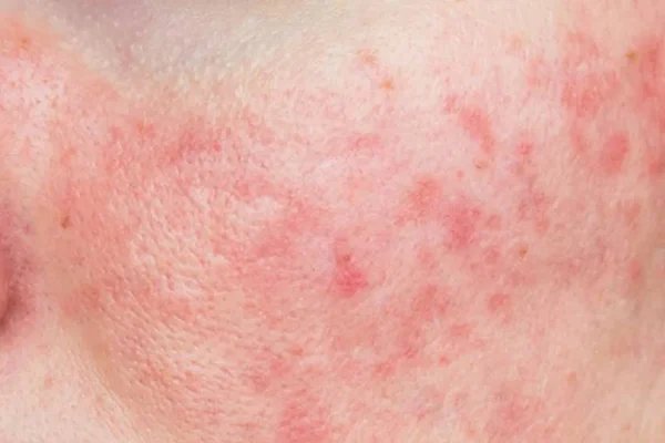 Rosacea 