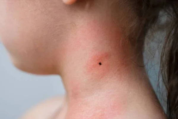Lyme hastalığı 