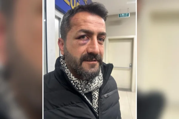 Polis şiddeti nedeniyle görme kaybı yaşıyor