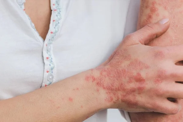 Epidermolizis Bülloza/Kelebek hastalığı