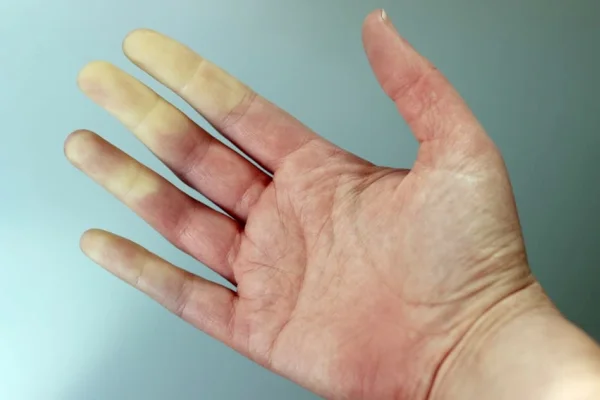 Raynaud hastalığı 