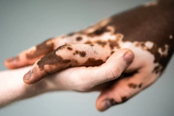 Vitiligo hastalığı
